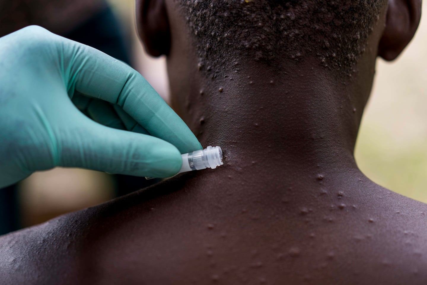 Monkeypox virus reported in a person who flew from Nigeria to Dallas